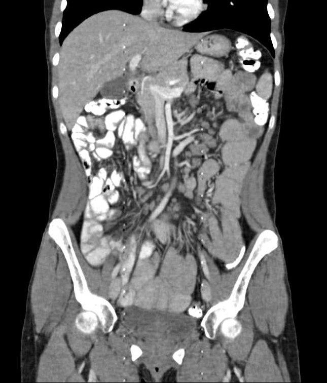 coronar