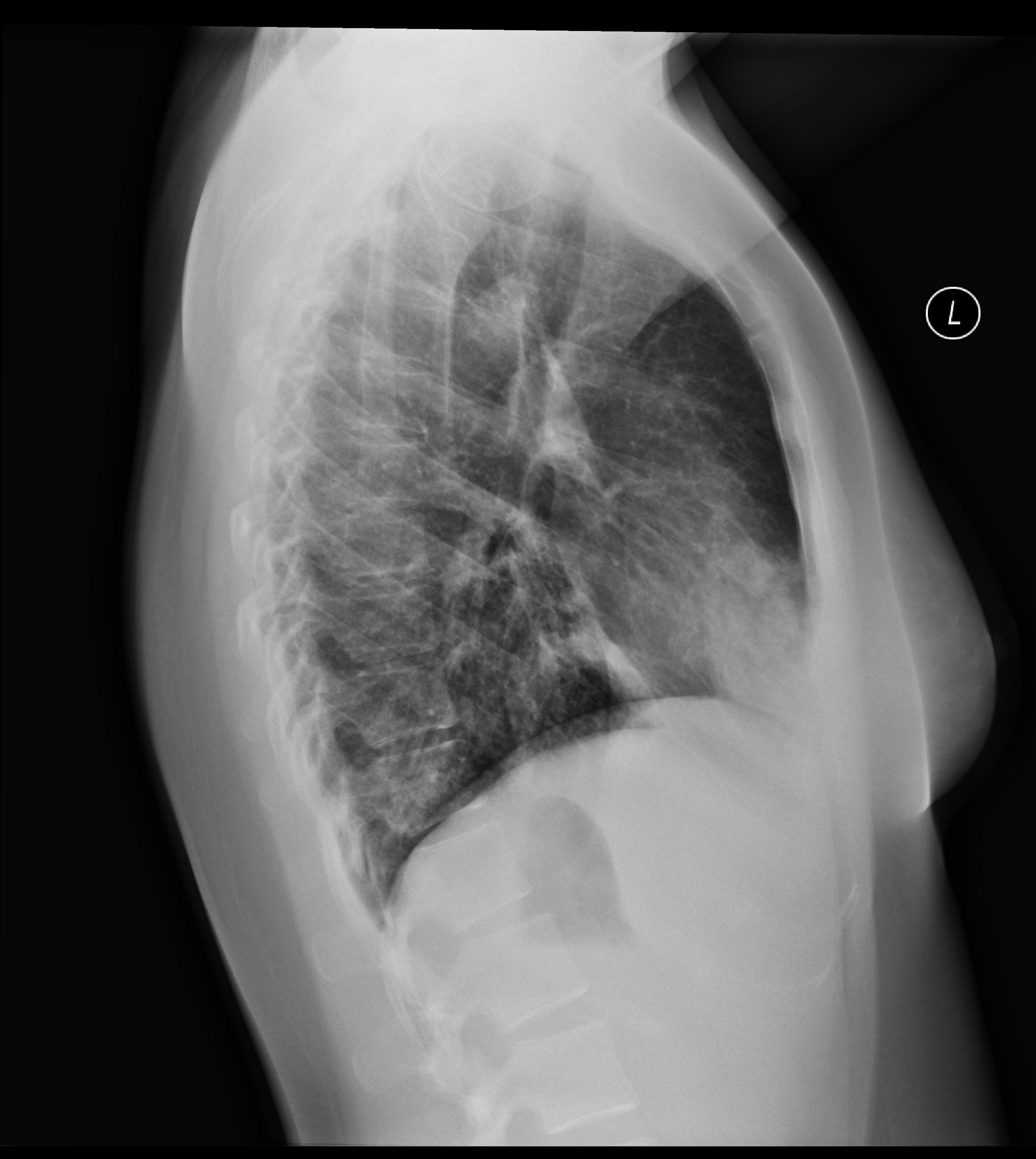 Lateral