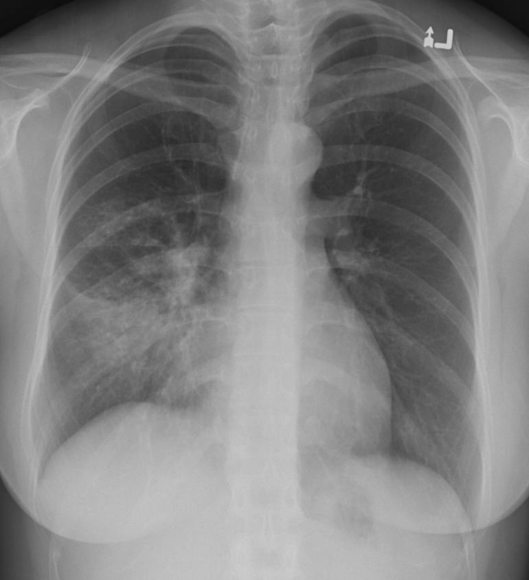 Röntgen-Thorax p.a.