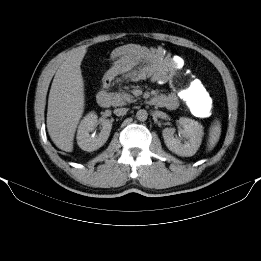 Abdomen axial nativ