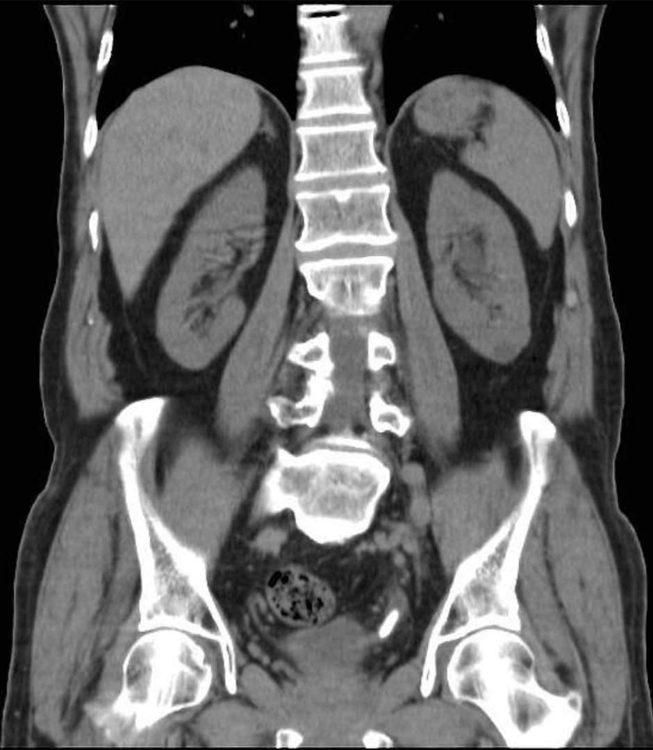 CT nativ coronar