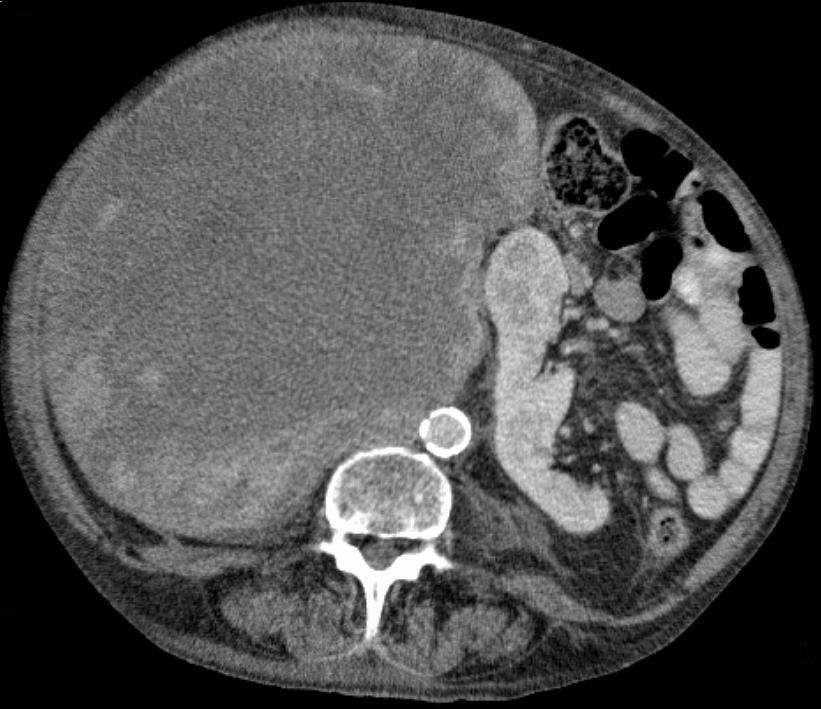 https://radiopaedia.org/cases/1e7aee5f19335f13d94be07a7a528d98
