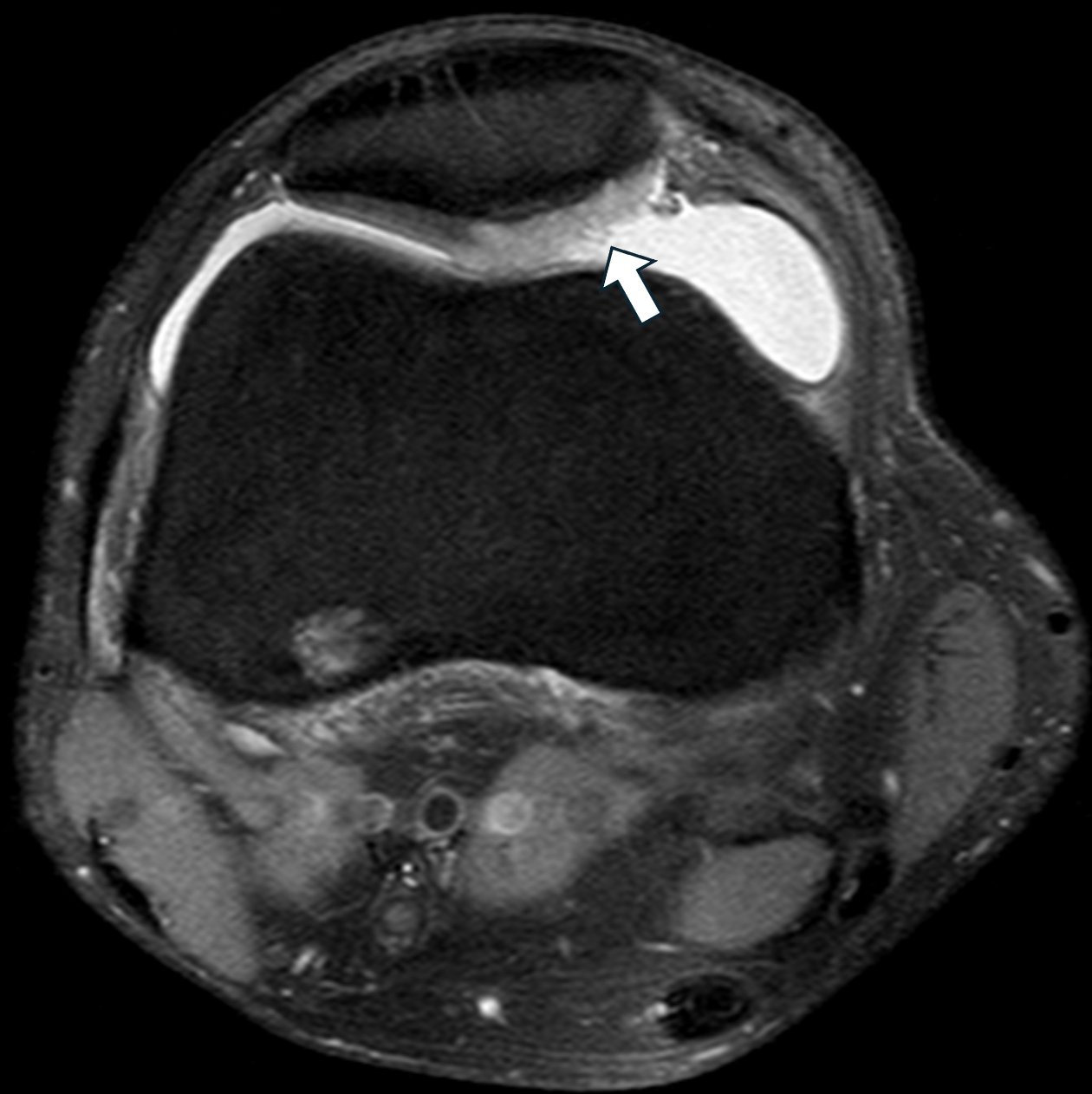 chondromalacia patella